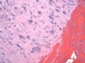子宫刮出物_超常胎盘反应 exaggerated placental site图4