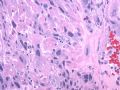 子宫刮出物_超常胎盘反应 exaggerated placental site图5