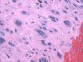 子宫刮出物_超常胎盘反应 exaggerated placental site图6
