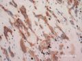 子宫刮出物_超常胎盘反应 exaggerated placental site图7