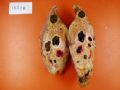 肝肿瘤－－肝内胆管多发性结石伴胆管上皮增生、恶变图20