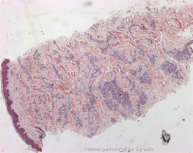 （转）M28Y, a red thigh nodule for 6 months suggestive of KS图1