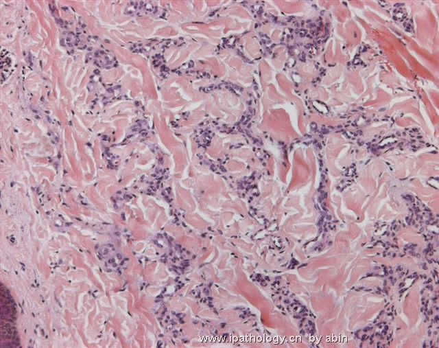 （转）M28Y, a red thigh nodule for 6 months suggestive of KS图2