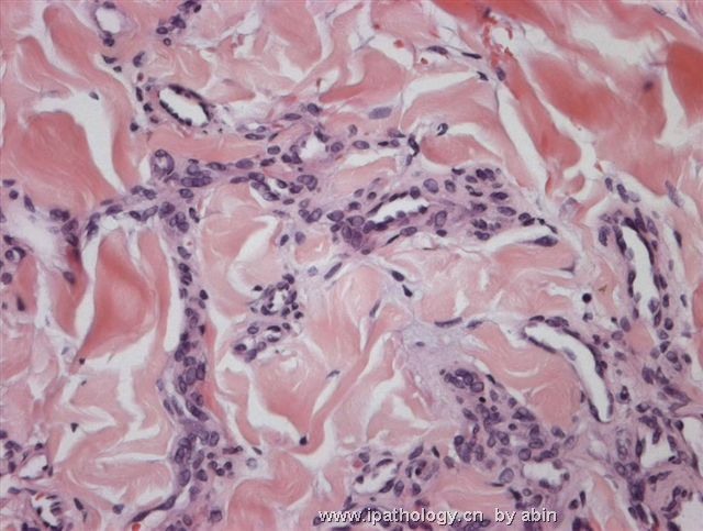 （转）M28Y, a red thigh nodule for 6 months suggestive of KS图3