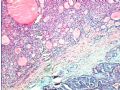 甲状腺肿物图11