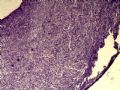 右颈淋巴结肿大图3