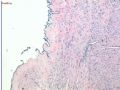 子宫浆膜结节囊肿病变图4