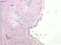 子宫浆膜结节囊肿病变图5