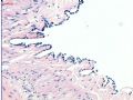 子宫浆膜结节囊肿病变图7