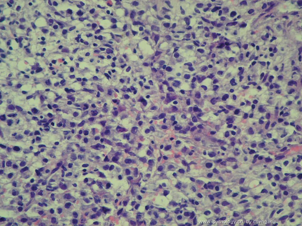 腹腔淋巴结穿刺－386012图3