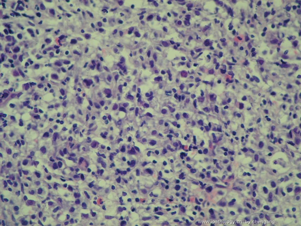 腹腔淋巴结穿刺－386012图4