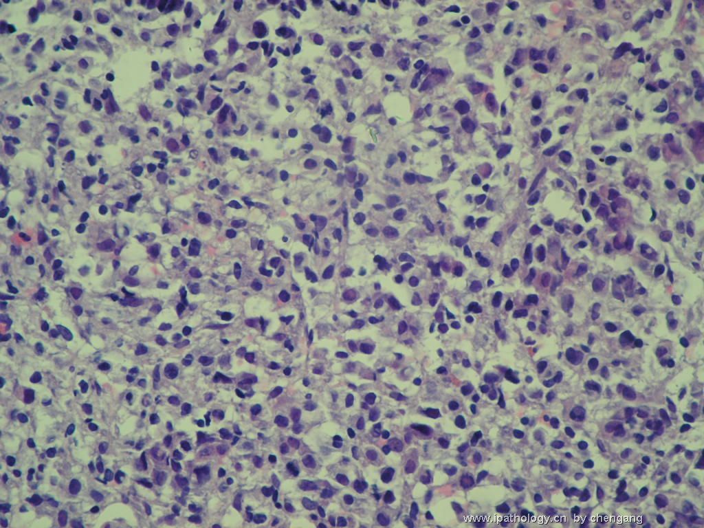 腹腔淋巴结穿刺－386012图5