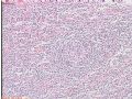 颈部右侧淋巴结肿大图18
