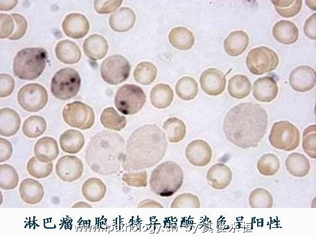 T细胞非霍奇金淋巴瘤并发淋巴瘤细胞白血病图19