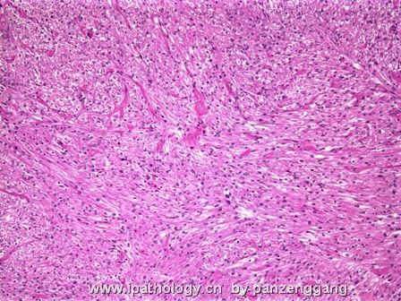 renal mass图2