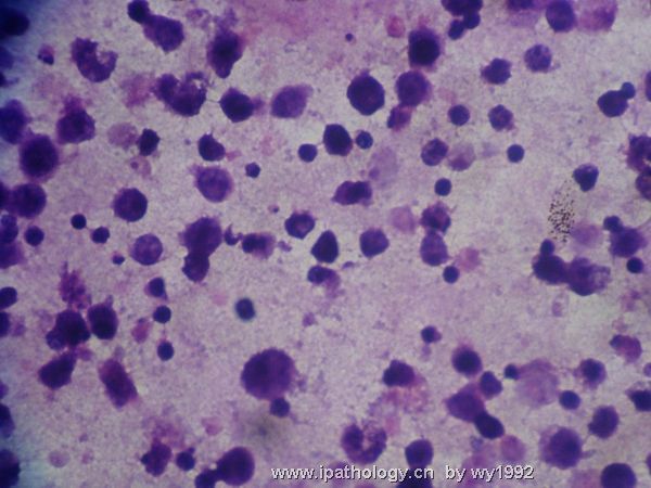 胸水涂片+细胞学切片图2