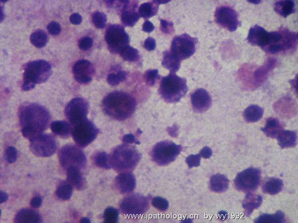 胸水涂片+细胞学切片图3