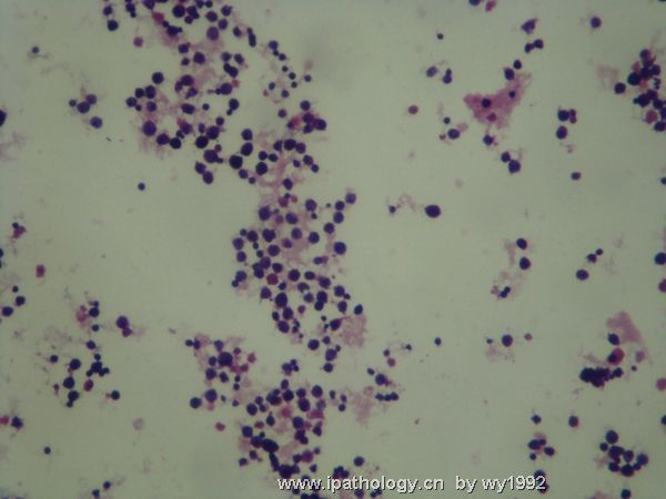 胸水涂片+细胞学切片图4