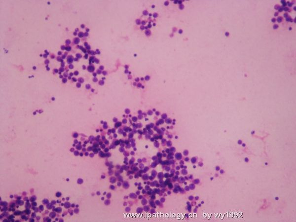 胸水涂片+细胞学切片图7