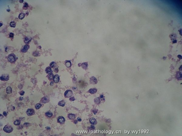 胸水涂片+细胞学切片图9