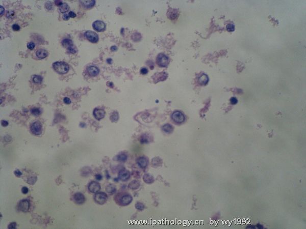 胸水涂片+细胞学切片图10