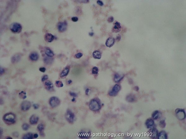 胸水涂片+细胞学切片图11