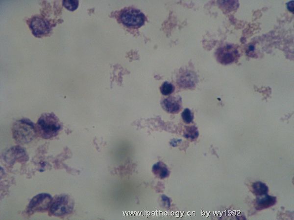 胸水涂片+细胞学切片图12