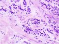 65 year old man with right neck mass (ss111008)图4