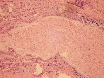 求助,甲状腺可以有原发的腺样囊性癌吗?图7