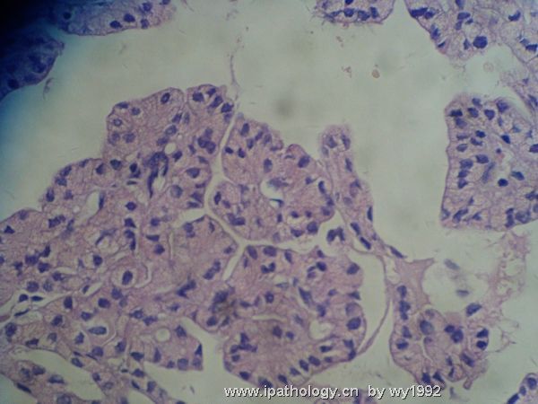 甲状腺肿快图2