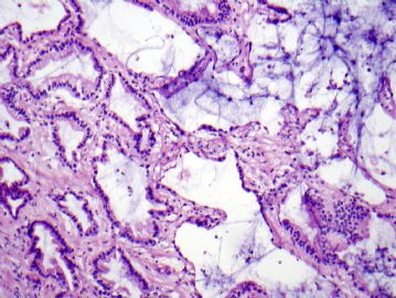 74 year old man with 1.0 cm lung nodule (12052008)图1