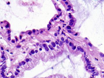 74 year old man with 1.0 cm lung nodule (12052008)图3