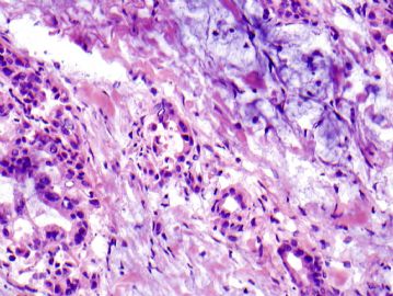 74 year old man with 1.0 cm lung nodule (12052008)图4