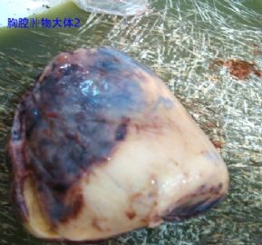 胸腔肿瘤，请老师帮忙给予诊断，谢谢图2