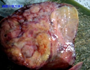 胸腔肿瘤，请老师帮忙给予诊断，谢谢图3