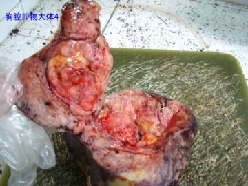 胸腔肿瘤，请老师帮忙给予诊断，谢谢图4
