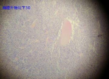 胸腔肿瘤，请老师帮忙给予诊断，谢谢图35