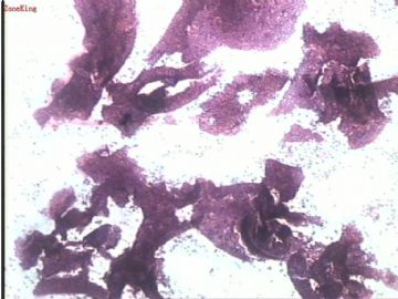女，36岁，乳腺肿物印片-已上传组织切片对照图1