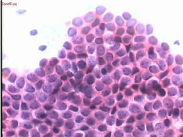 女，36岁，乳腺肿物印片-已上传组织切片对照图3