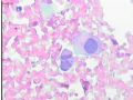 乳头溢液涂片图15