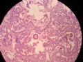 甲状腺肿物图3