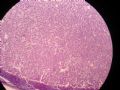 甲状腺肿物图5