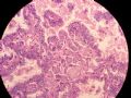 甲状腺肿物图6