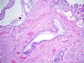 [已确证] 膀咣肿物：宫颈腺体异位 endocervicosis图3