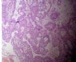 替丝哥芽发的病例：宫颈赘生物图5