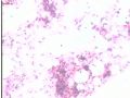 分享--直肠肿瘤术中印片图2
