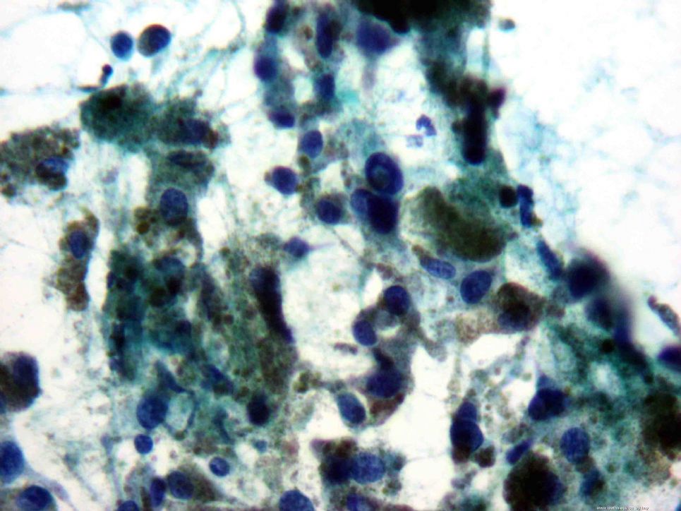 颈淋巴结穿刺(Melanoma)图1
