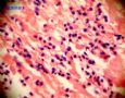 甲状腺肿瘤，请各位老师诊断图8