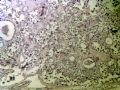 085164/313723右甲状腺图2