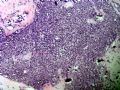 肋骨旁肿瘤STHUIT\final diagnosis 间叶性软骨肉瘤图3